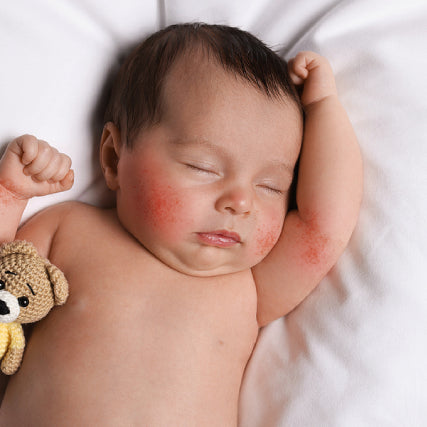 Types Of Baby Rashes And How To Effectively Treat Them